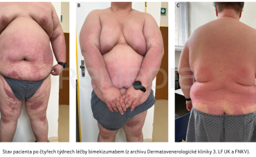 OBR. 2A–C Stav pacienta po čtyřech týdnech léčby bimekizumabem