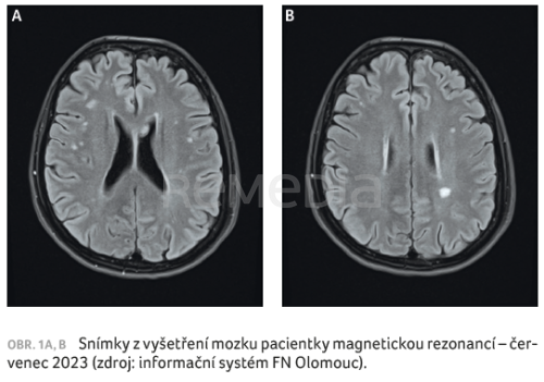 Ofatumumab v terapii roztroušené sklerózy a adherence k léčbě – kazuistika
