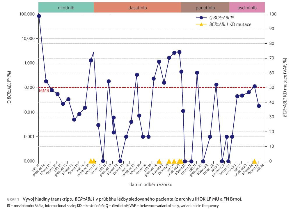 GRAF 1 Vývoj hladiny transkriptu BCR::ABL1 v průběhu léčby sledovaného pacienta (z archivu IHOK LF MU a FN Brno).